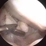 Arthroskopie-2