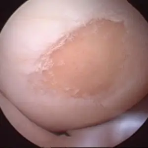 Arthroskopie-3